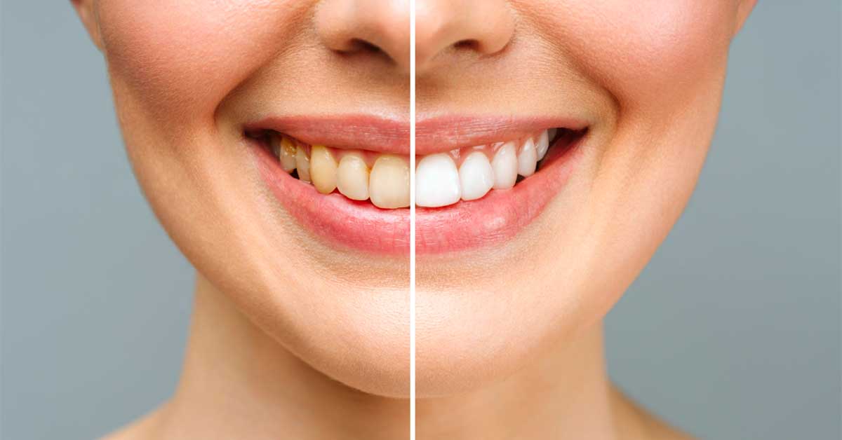 Side Effects Following Professional Teeth Whitening
