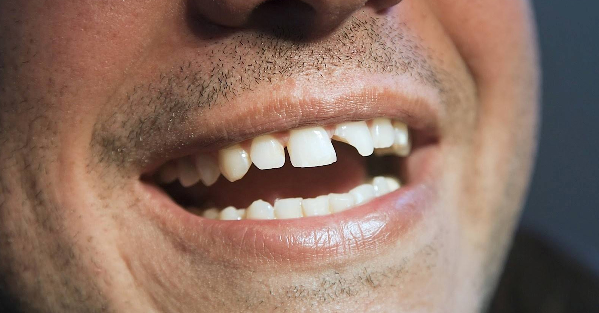 What is Broken Tooth?