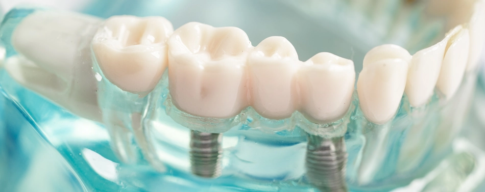 What Should Be Considered After an Implant