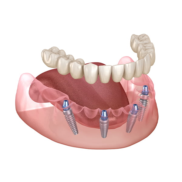 all on four implants