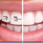 Diş Teli Ortodontist Tedavilerin Önemi