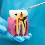 Kanal Tedavisi Sonrası Neler Olur? Ağrı, Şişlik ve İyileşme Süreci