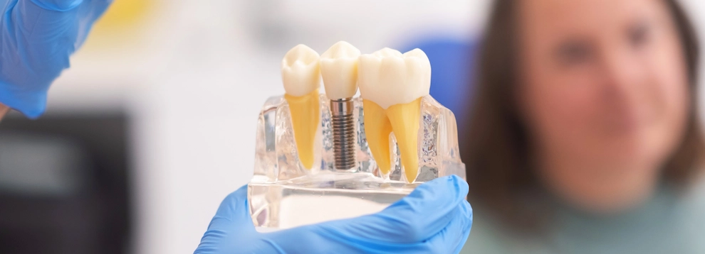1 diş implant fiyatları