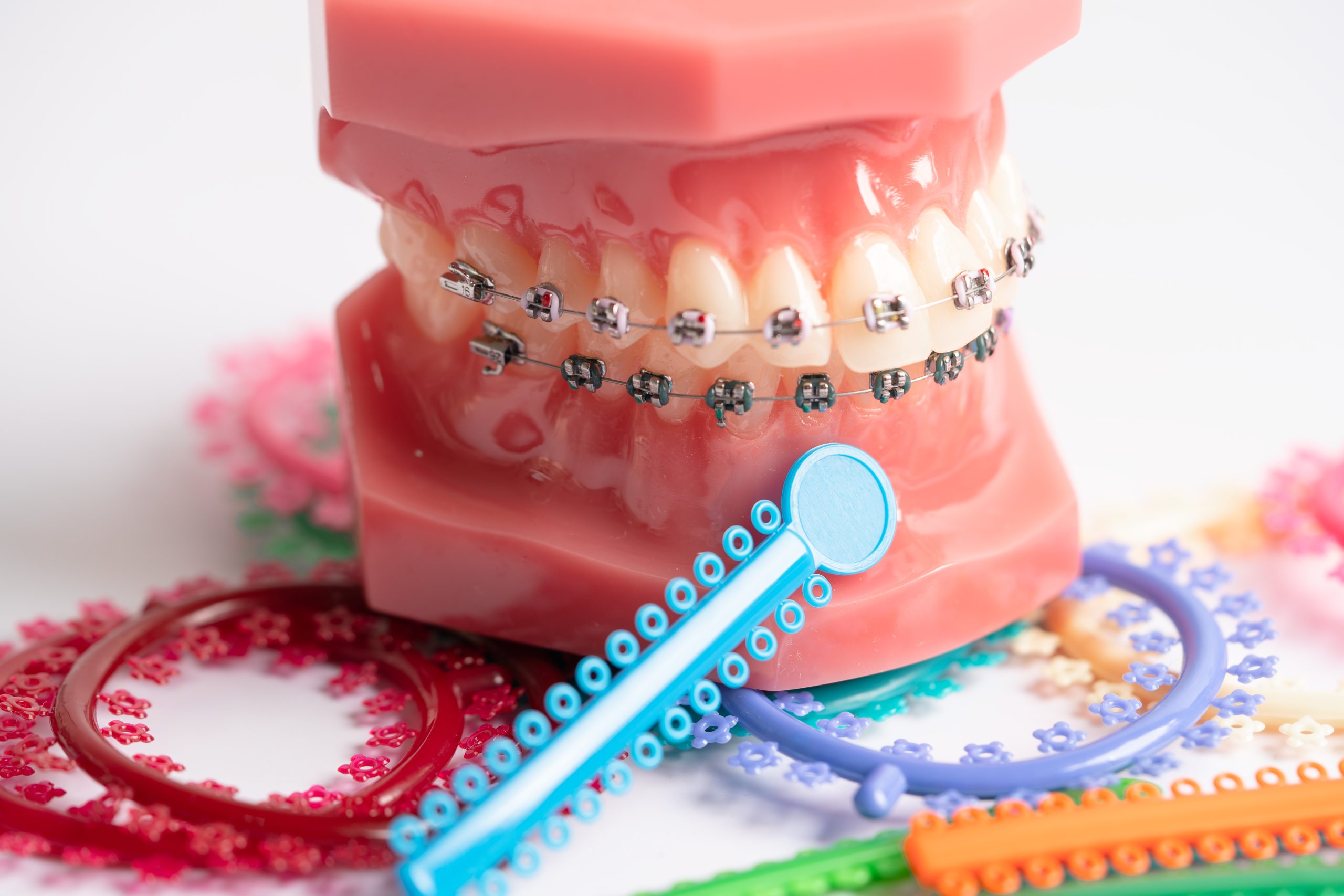 diş teli kaç yaşında takılır