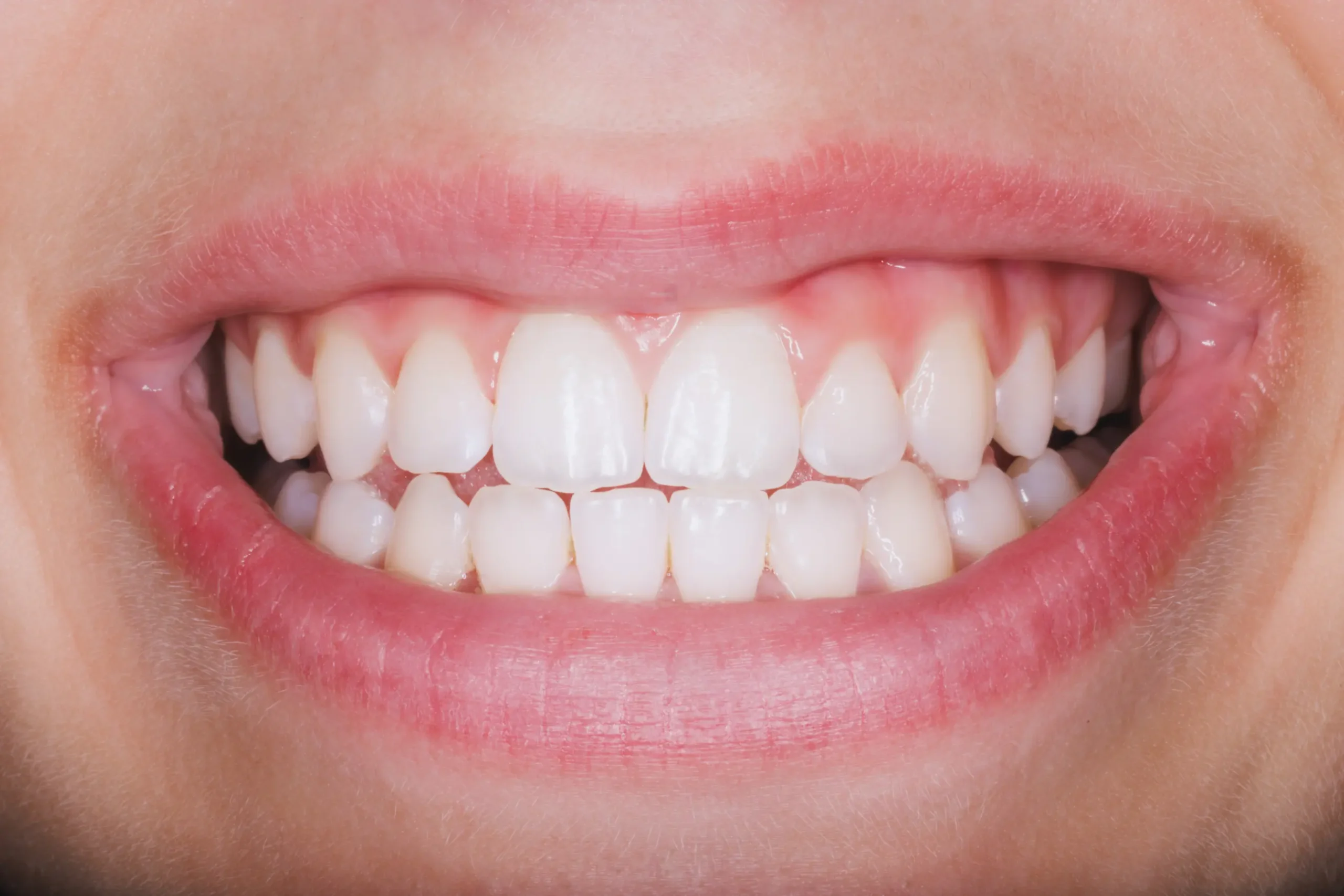 Gingivitis Nedir